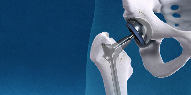 Hip Replacement Surgery