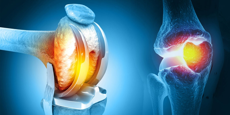 Revision Joint Replacement Surgery